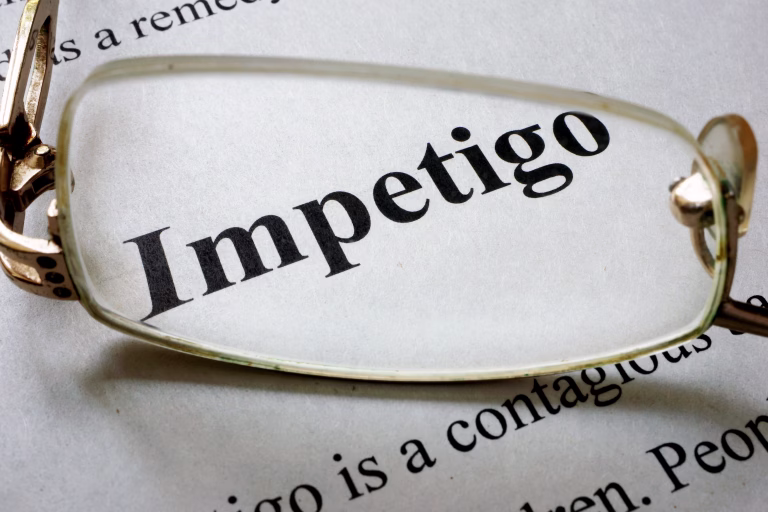 Paper with word Impetigo and glasses. Medical concept.