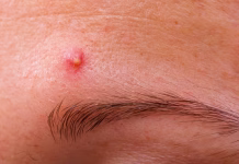 Ali so norice pri odraslih res tako nevarne? Skrita tveganja, ki jih ne smete spregledati The infected pustulous acne on the forehead