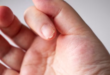 Lomljivi nohti: kaj vam s tem sporoča telo? The nails are crack nails.