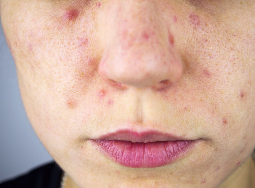 Young woman with acne, melasma, dark spots, freckles on his face. Dermatology, problem skin care and health concept image. Part of body, selective focus.
