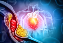 Nova tableta za holesterol obeta prelom v preprečevanju srčno-žilnih bolezni Cholesterol blocked artery with heart. 3d illustration