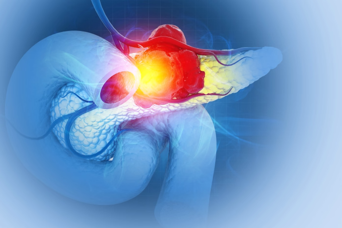 pancreatic-cancer-is-cancer-that-forms-in-the-cells-of-the-pancreas-3d-illustration-stockpack-istock Pancreatic cancer is cancer that forms in the cells of the pancreas. 3d illustration