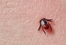 Klopi so še tu: kako se jim zoperstaviti pred poletjem? Sucking tick Macro photo on human skin. Ixodes ricinus. Bloated parasite bitten into pink irritated epidermis. Small red drops. Dangerous insect mite. Encephalitis, Lyme disease infection.