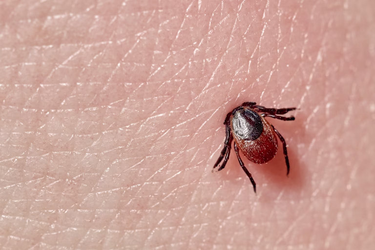 Sucking tick Macro photo on human skin. Ixodes ricinus. Bloated parasite bitten into pink irritated epidermis. Small red drops. Dangerous insect mite. Encephalitis, Lyme disease infection.