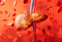 Nova eksperimentalna terapija za zamaščena jetra Liver organ with fatty liver state, 3d rendering. 3D illustration.