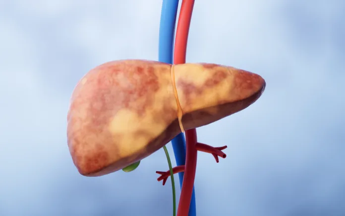 liver-organ-with-fatty-liver-state-3d-rendering-3d-illustration-stockpack-istock Liver organ with fatty liver state, 3d rendering. 3D illustration.