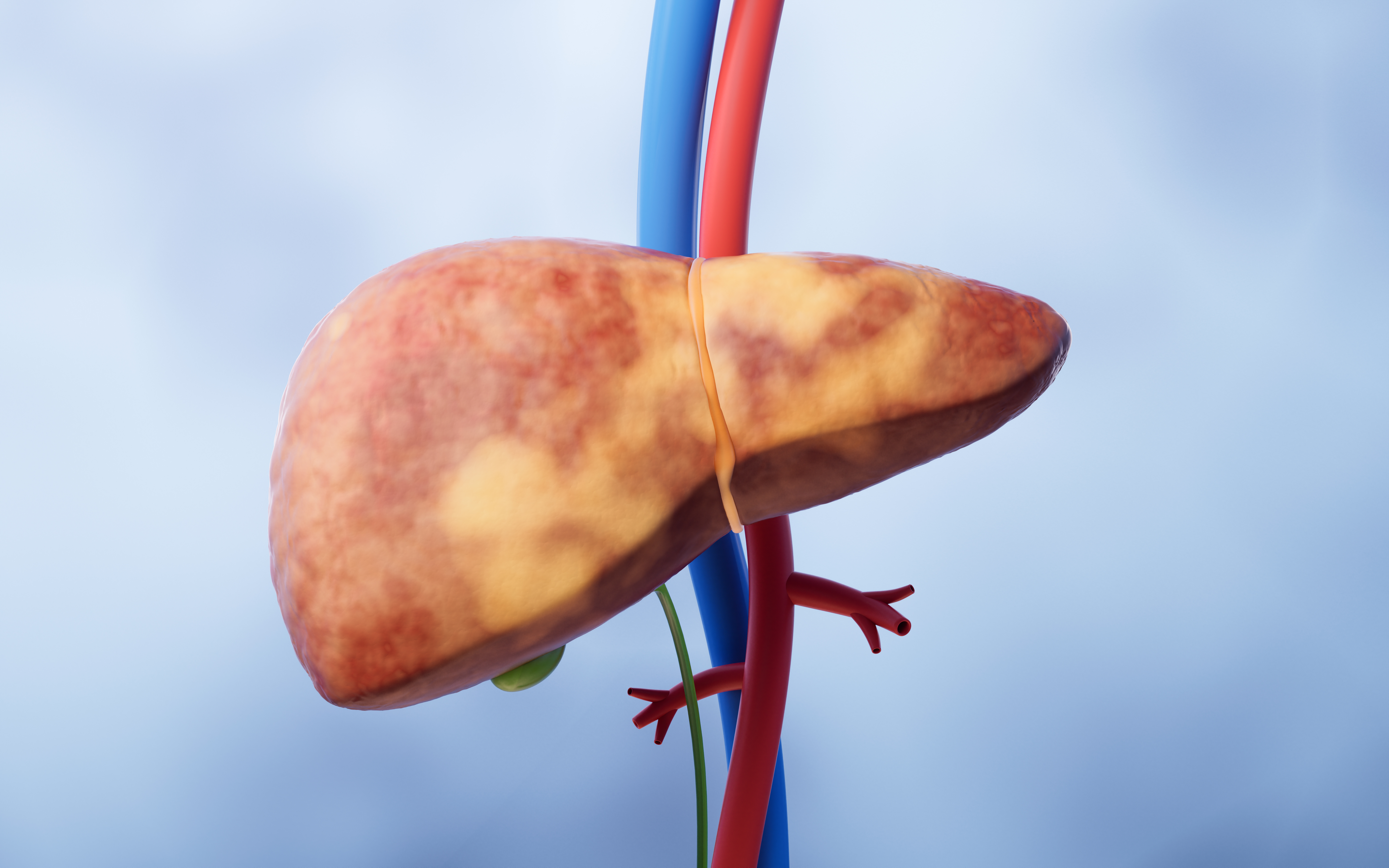 Liver organ with fatty liver state, 3d rendering. 3D illustration.
