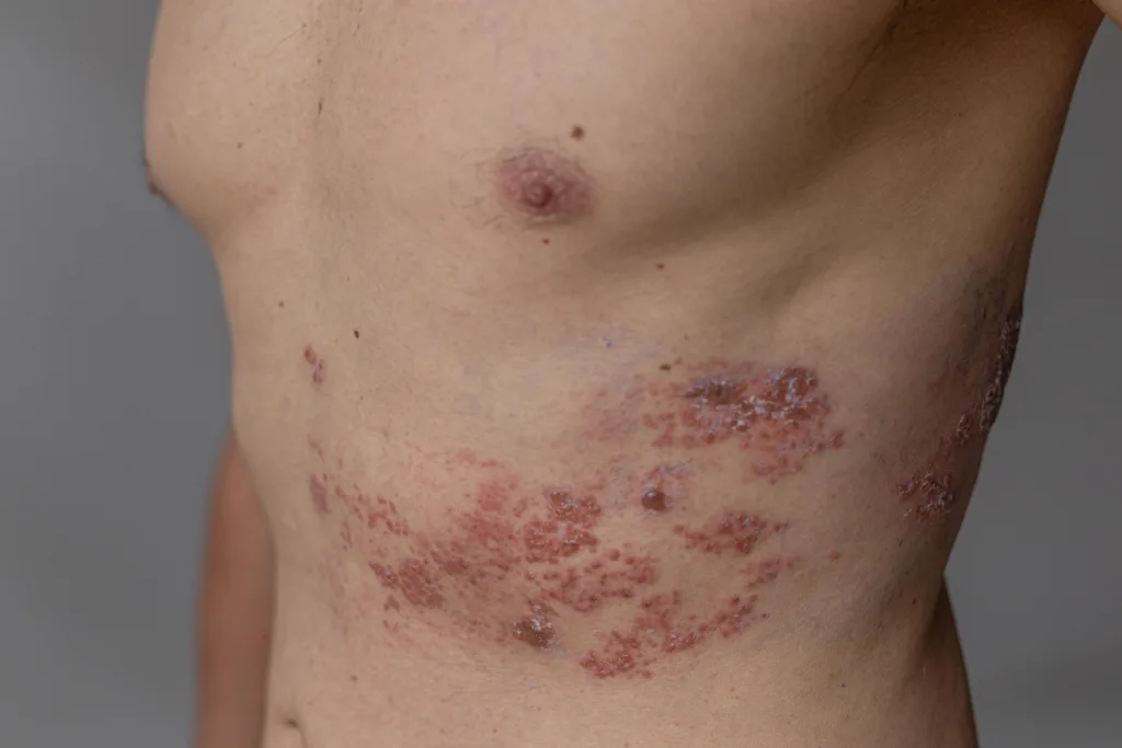 A close-up image showing a shingles (herpes zoster) rash on the side of an adult male's torso. The skin is visibly inflamed, with clusters of red, blistering lesions following a nerve path. This condition is caused by the varicella-zoster virus and is often painful.