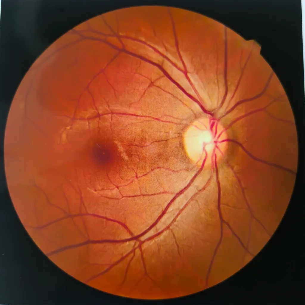 Medische Fundus foto van retinopathy bloeding. Medische Fundus foto van netvliespathologie, hemmorhages, aderocclusie, macular degeneratie