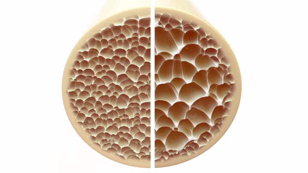 healthy boneand and osteoporosis bone - direct comparison -- 3D Rendering