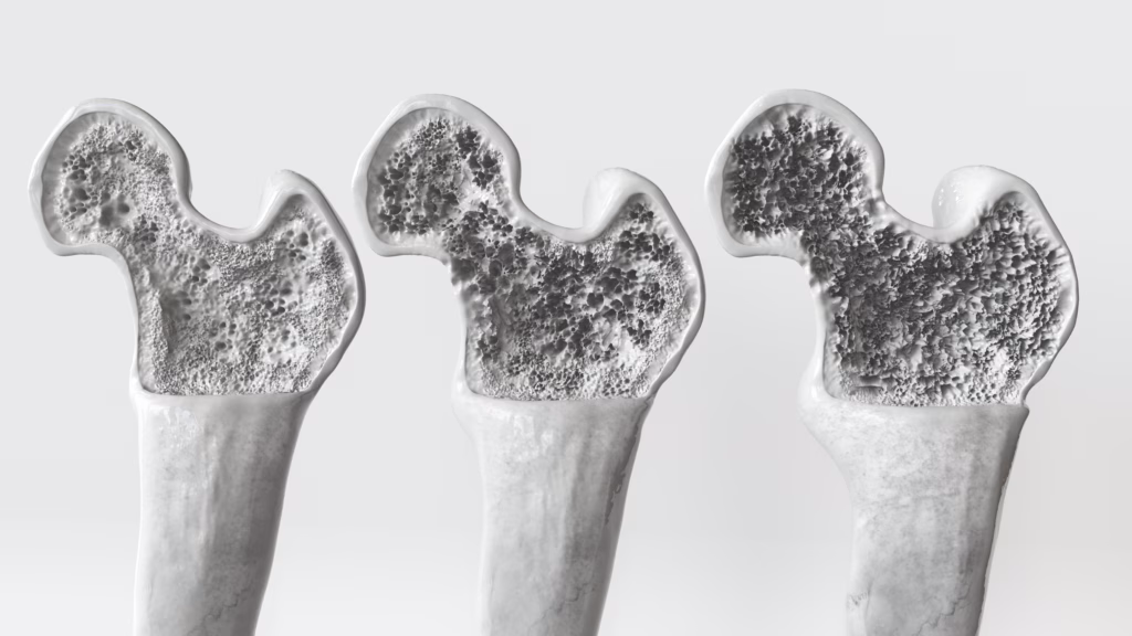 Osteoporosis 3 Stages -- 3D Rendering